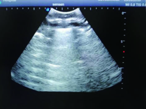 Thoracentesis Ultrasound Training Model