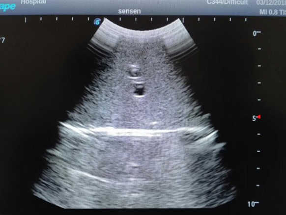 Abdominal Ultrasound Phantom