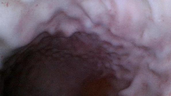 Upper GI Endoscopy Training Model