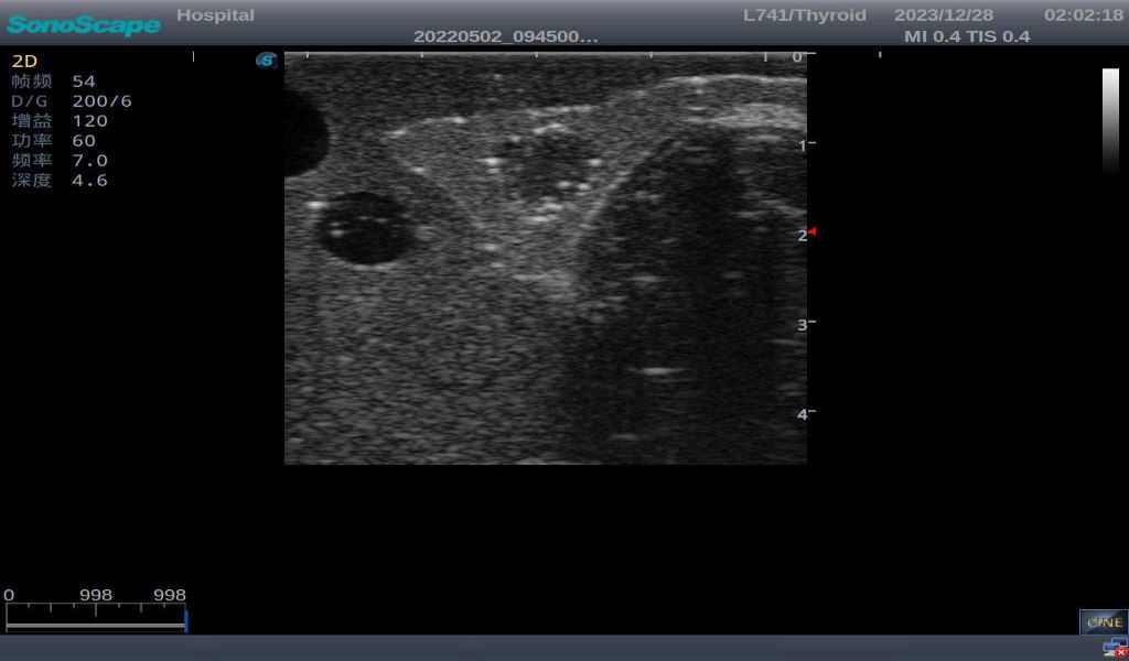 Thyroid Ultrasound Training Model